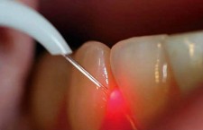 зубы стоматолог лазер